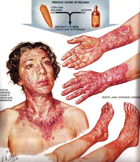 Pellagra Dermatitis